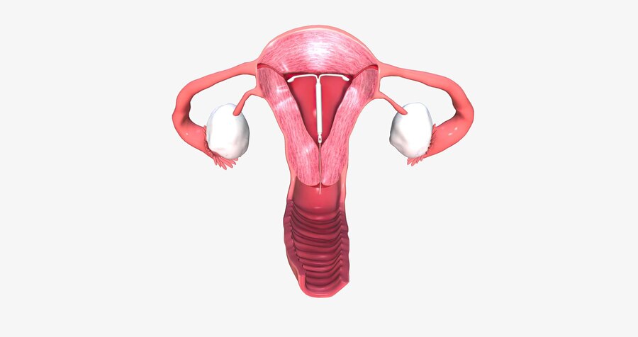 Mirena IUD Learn About Birth Control Method