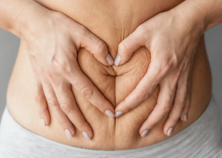 Diastasis Recti Expert Treatment Options and Recovery
