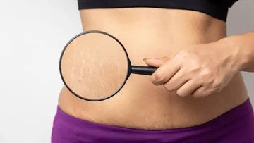 Stretch Marks